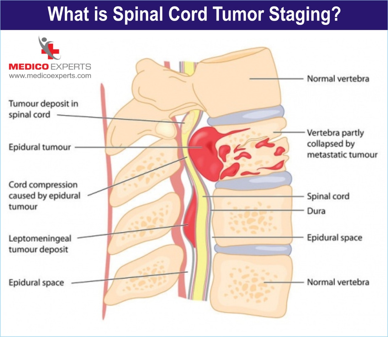 what is spinal cord tumor staging