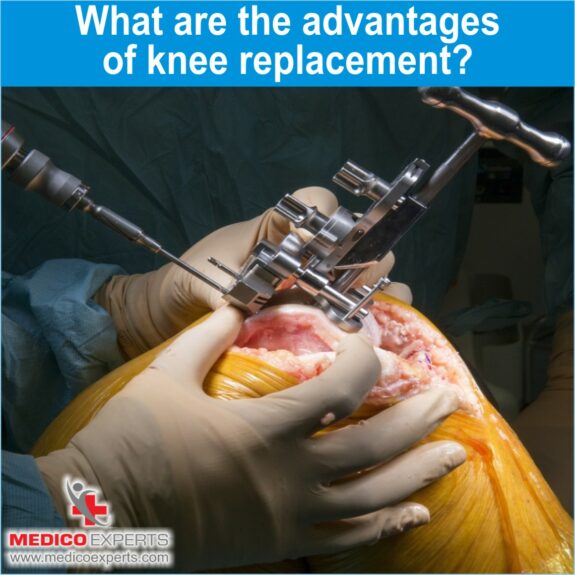 What are the advantages of knee replacement1 Advantages of knee replacement, best knee replacement surgeon in india