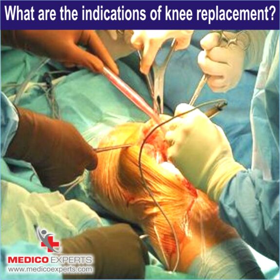 What are the indications of knee replacement, best knee replacement surgery in india