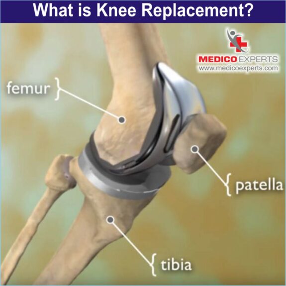 What is Knee Replacement, latest technology in knee replacement surgery in india