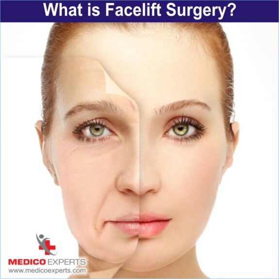 What is facelift surgery,facelift surgery in india