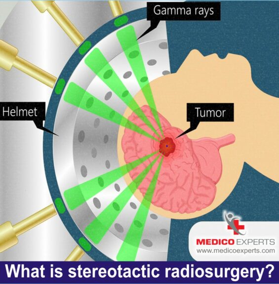 What is stereotactic radiosurgery