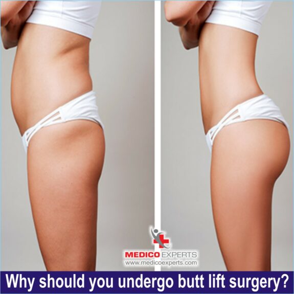 Why should you undergo butt lift surgery