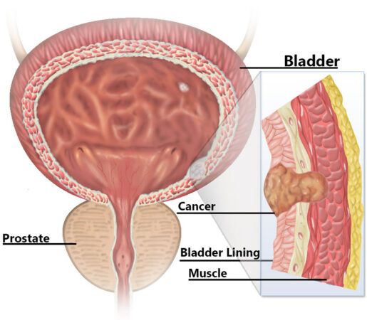 bladder cancer treatment in india, turbt procedure