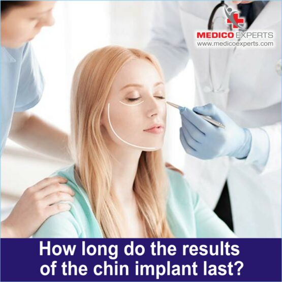 How long do the results of the chin implant last