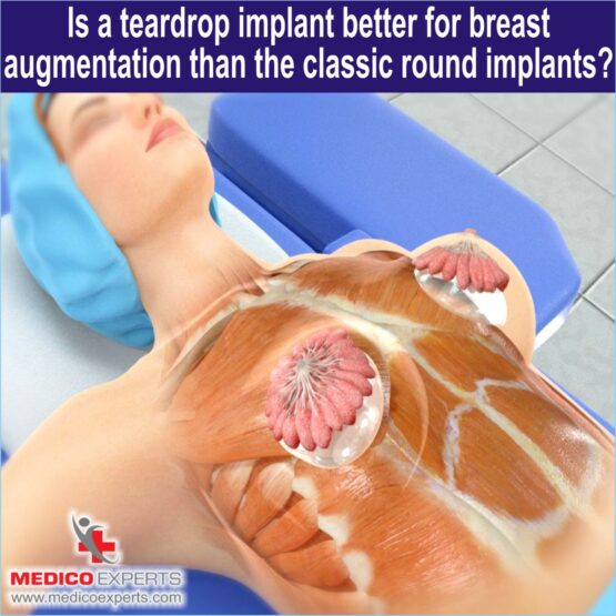 Is a teardrop implant better for breast augmentation than the classic round implants