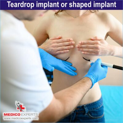 Teardrop implant or shaped implant