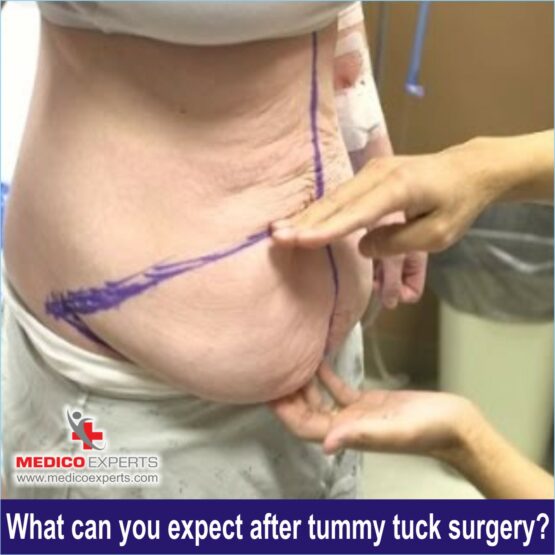 tummy tuck surgery in India