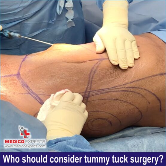 Tummy Tuck Surgery in india