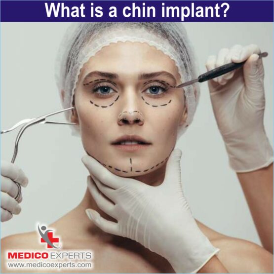 What is a chin implant
