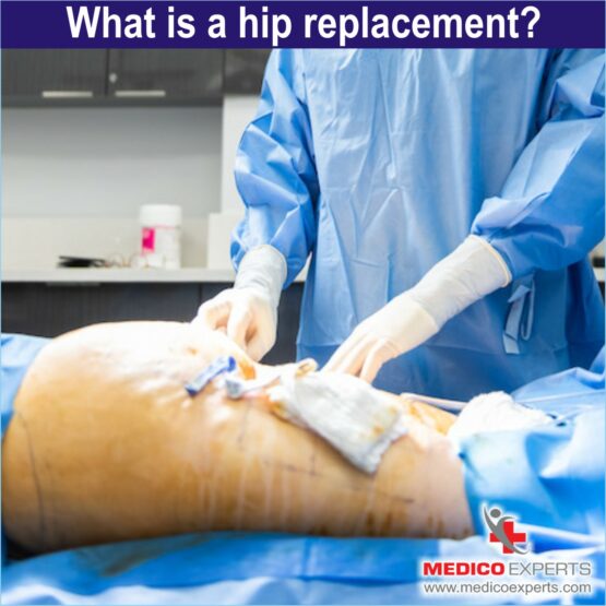 What is a hip replacement, Hip replacement surgery in India