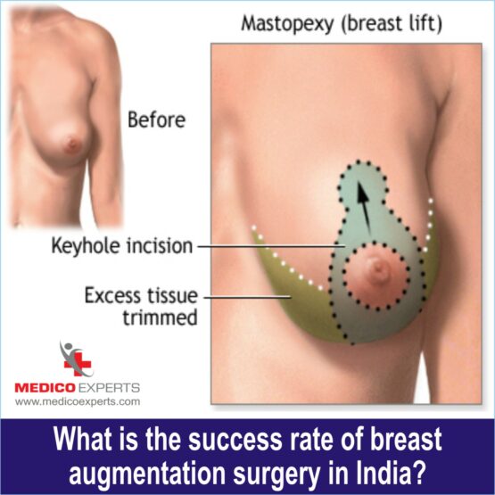 What is the success rate of breast augmentation surgery in India
