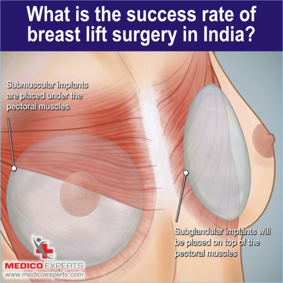 Success rate of breast lift surgery in India
