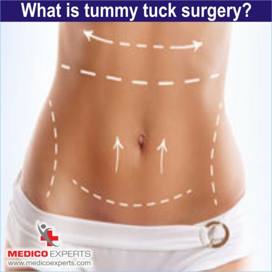 What is tummy tuck surgery - abdominoplasty