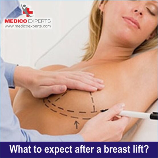 What to expect after a breast lift