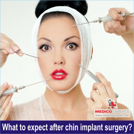 What to expect after chin implant surgery, before and after chin implant