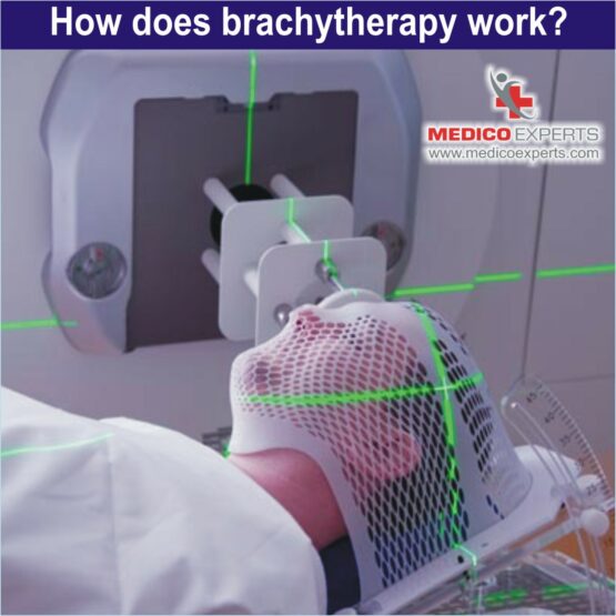 How does brachytherapy works?