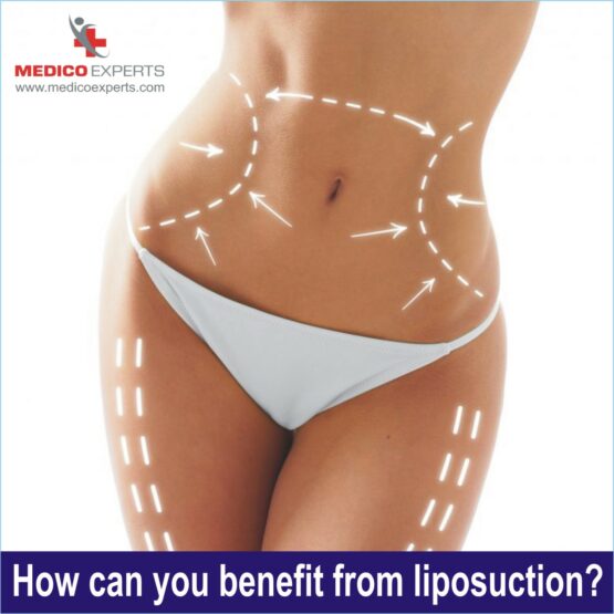 benefits of liposuction, liposuction surgery in india