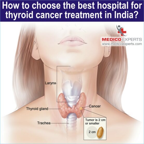 Best hospital for thyroid cancer treatment in India, best thyroid cancer hospital in india