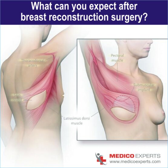 breast reconstruction surgery