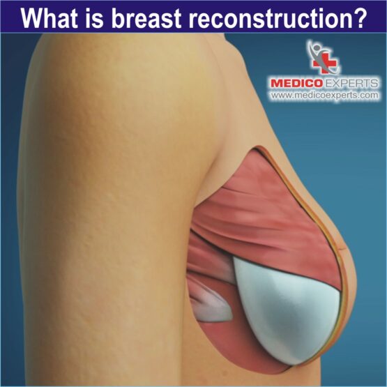 what is breast reconstruction