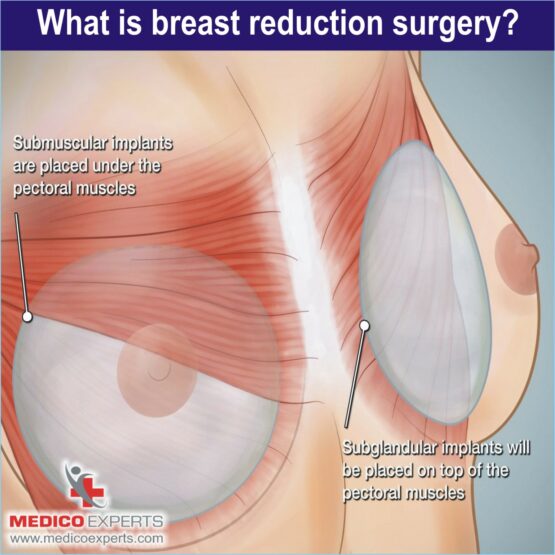 what is breast reduction surgery