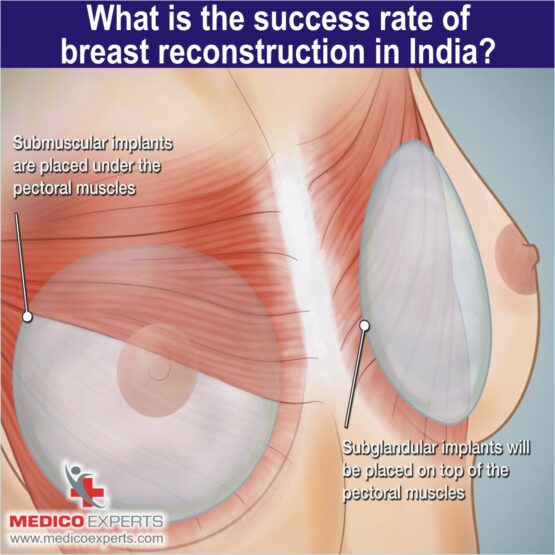 What is the success rate of breast reconstruction in India 1 success rate of breast reconstruction surgery