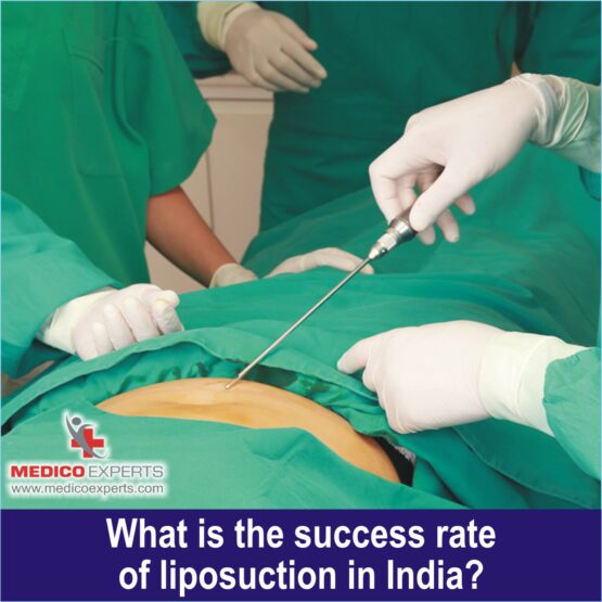 success rate of liposuction in India