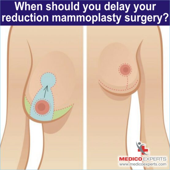 reduction mammoplasty surgery