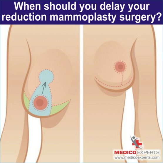 When should you delay your reduction mammoplasty surgery 1 reduction mammoplasty surgery