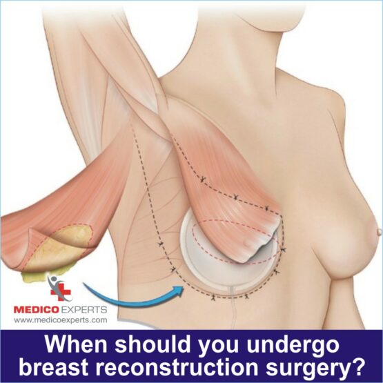 When should you undergo breast reconstruction surgery 1 breast reconstruction surgery