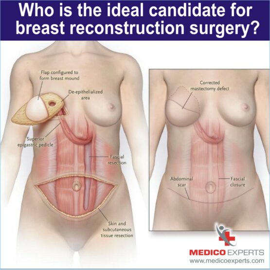 Ideal candidate for breast reconstruction surgery