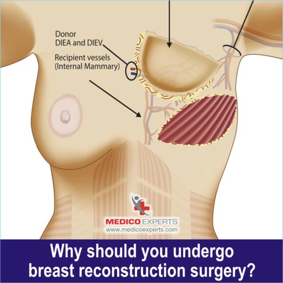 breast reconstruction surgery in India