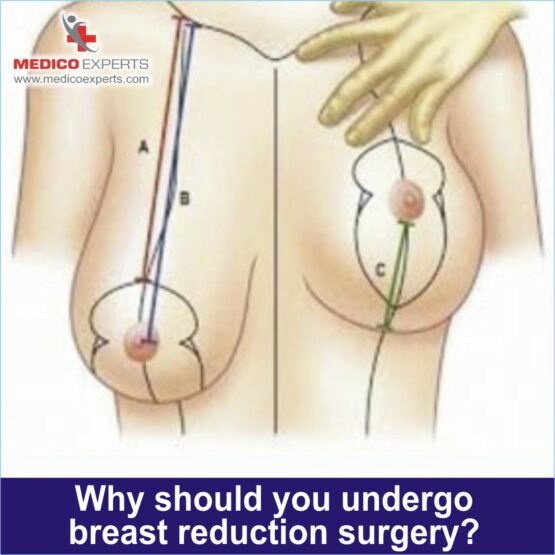 Why should you undergo breast reduction surgery 1 breast reduction