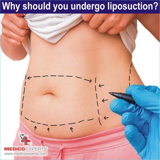 why should you undergo liposuction, best liposuction in india