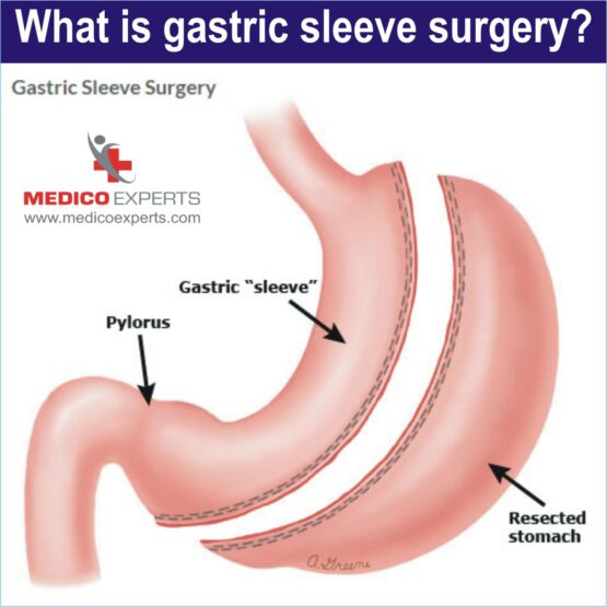 what is Gastric Sleeve Surgery