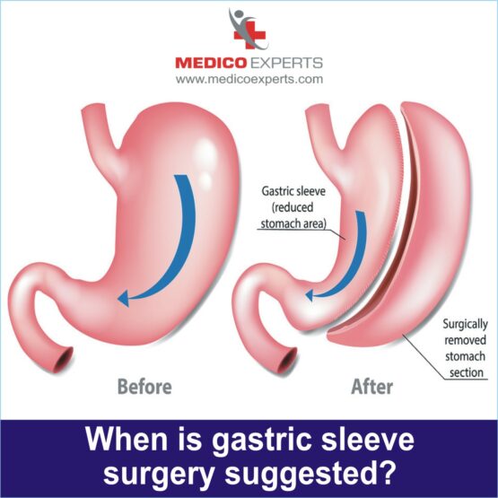 Gastric Sleeve Surgery, price gastric sleeve surgery