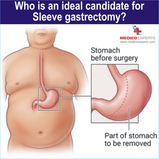 Gastric Sleeve Surgery, best laparoscopic sleeve gastrectomy surgery in india