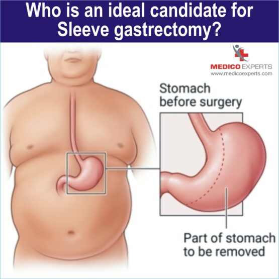 Gastric Sleeve Surgery Gastric Sleeve Surgery, best laparoscopic sleeve gastrectomy surgery in india