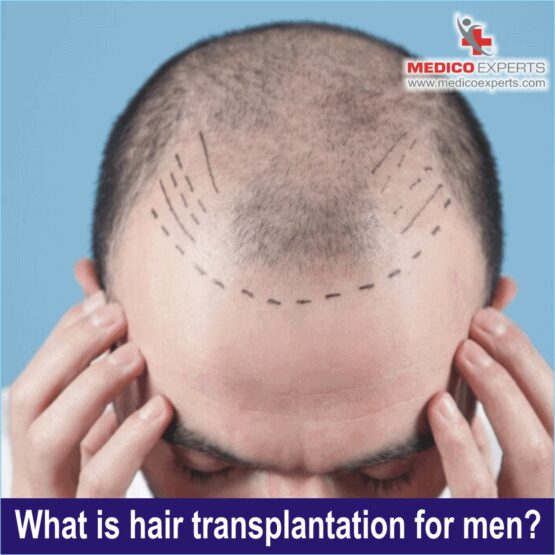 best hair transplant in india