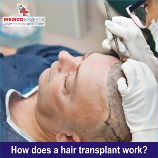 How does hair transplant works?, hair transplant side effects
