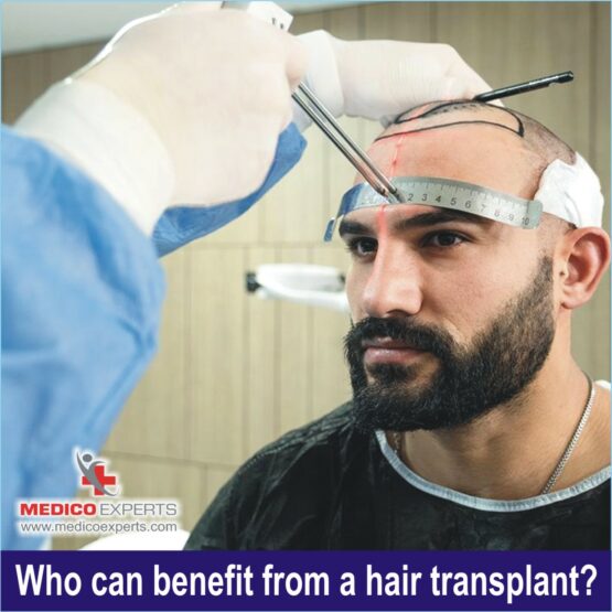Who can benefit from hair transplant?, best hair transplant in india