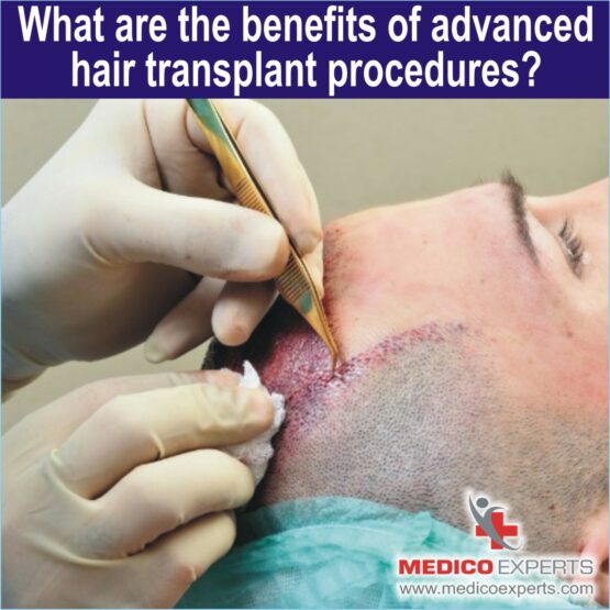 advanced hair transplant advanced hair transplant, hair transplant before and after