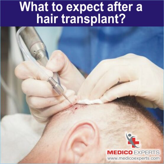 what to expect from hair transplant, hair rejuvenation