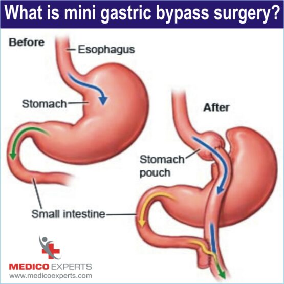 what is Mini gastric Bypass Surgery, mini gastric bypass procedure