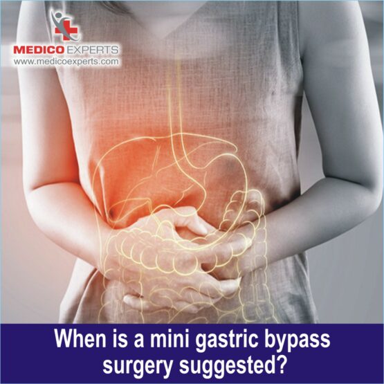 Mini gastric Bypass Surgery, best mini gastric bypass surgery in india