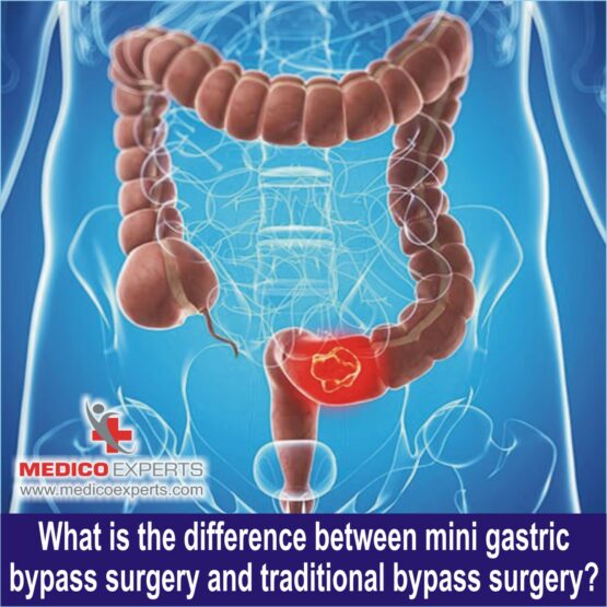 Mini gastric Bypass Surgery