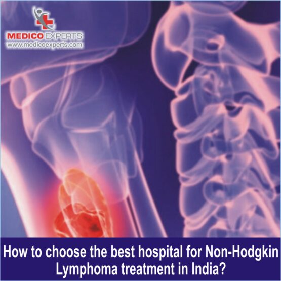 best hospital for treating non hodgkin's lymphoma, non-hodgkin lymphoma doctor