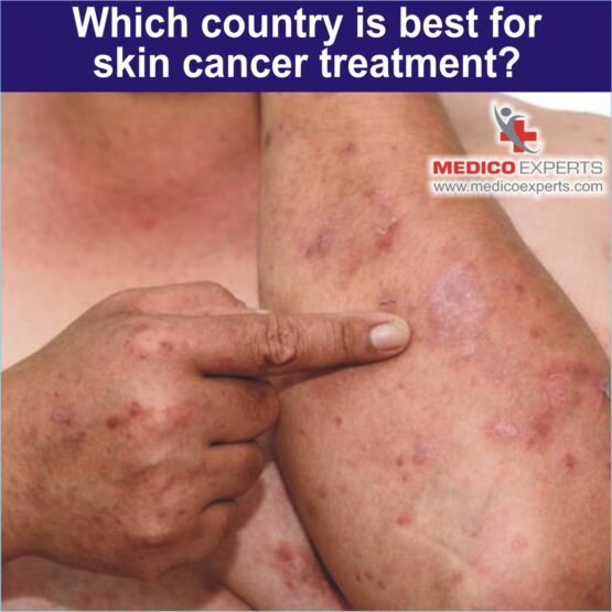 Best country for skin cancer treatment, best skin cancer treatment in india