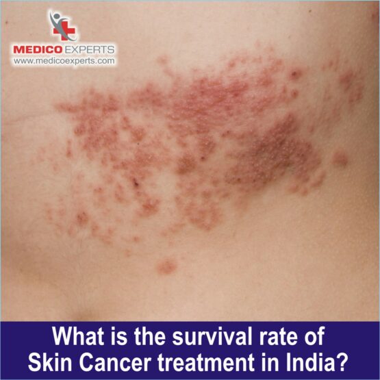 Survival rate of skin cancer treatment in india, success rate of skin cancer treatment in india